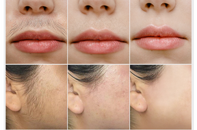 Painless facial hair removal cream - silkglide